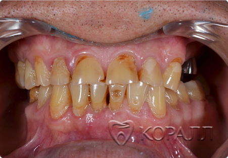 Зубы до восстановления коронками