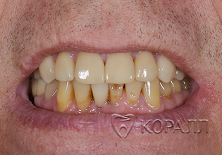 Зубы после восстановления коронками