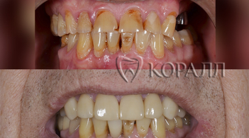 До-После протезирование коронками передних зубов