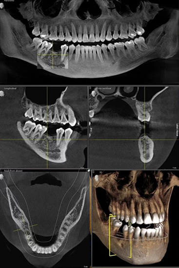 3д снимок зубов - КТ