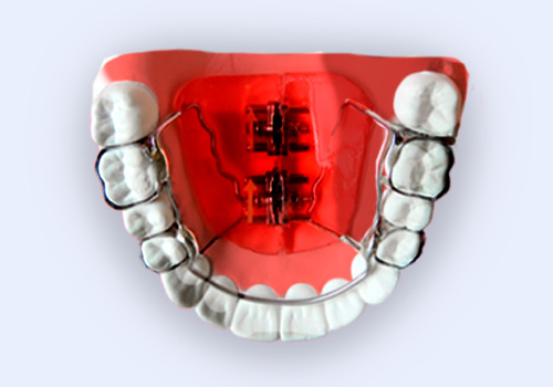 Пластина, ортодонтический аппарат