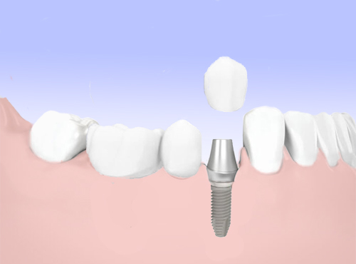 Коронка на импланте