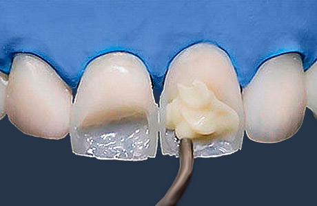 Художественная реставрация фронтальной группы зубов