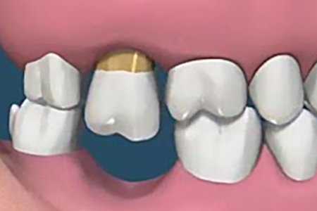 После удаления зуба