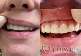 Реставрация передних зубов - после