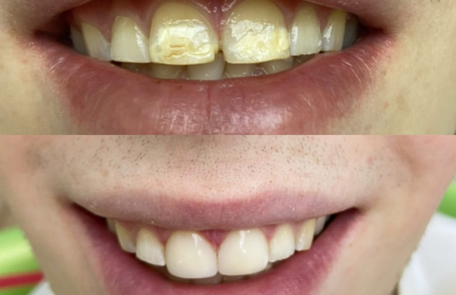 До-После художественная реставрация зуба