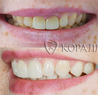До-После протезирование коронками передних зубов