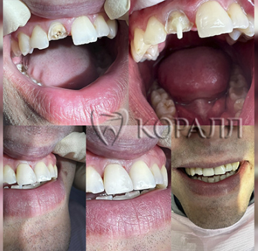 До-После художественная реставрация зуба