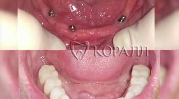 До-После протезирование на имплантах